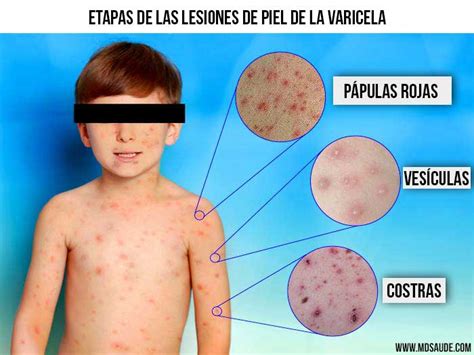 Lesiones de varicela en abdomen y otras zonas del cuerpo