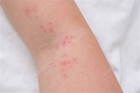 Reacción alérgica a penicilina (erupción extendida en el brazo)