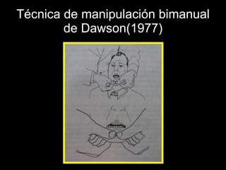 Ilustración de la técnica bimanual de Dawson