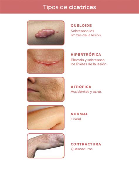 Diagrama comparativo que muestra las diferencias visuales entre una cicatriz normal, una cicatriz hipertrófica y un queloide.