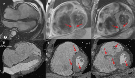 Diagrama que muestra la infiltración de grasa en el músculo de un jamón Duroc en comparación con otros jamones blancos.