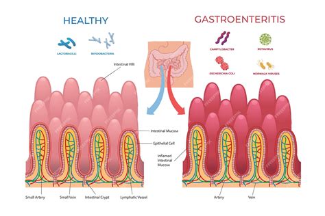 Infografía comparativa: diferencias entre el intestino sano y un intestino afectado por inflamación.