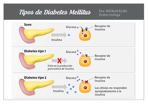 Diagrama que compara los tipos de diabetes (Tipo 1, Tipo 2, Gestacional).