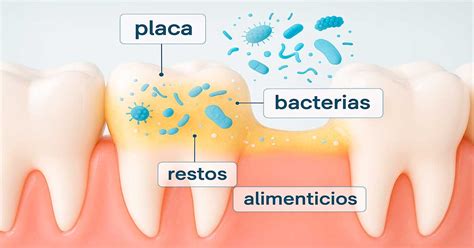 Infografía mostrando la acumulación de placa bacteriana y el desarrollo de sarro