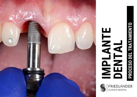Diagrama de los diferentes tratamientos correctivos dentales como implantes y fundas