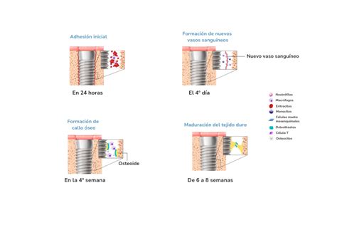 Diagrama de la cirugía de osteointegración, mostrando el implante de titanio en el hueso y el conector externo para la prótesis.