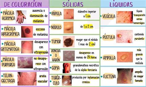 Esquema de las lesiones cutáneas y mucosas de la viruela aviar.