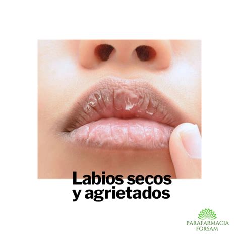 Ilustración de labios agrietados por el frío y un bálsamo labial casero con ingredientes naturales.