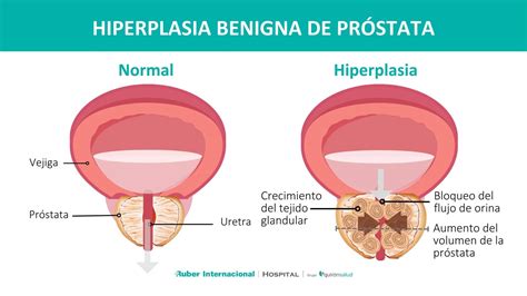 Corte transversal de próstata normal vs. próstata con HPB