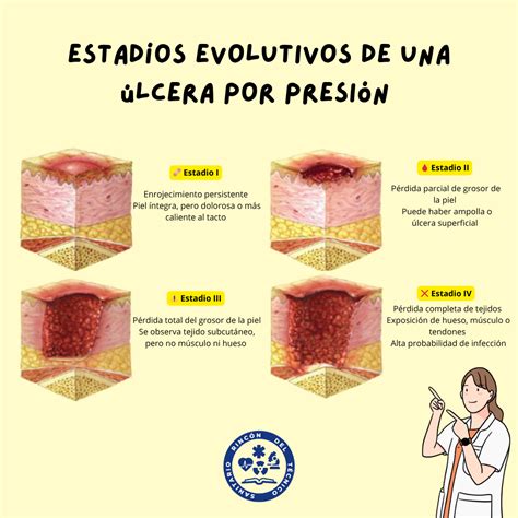 Infografía detallando las etapas de desarrollo de una úlcera por presión y las zonas del cuerpo más vulnerables.