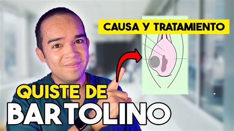 Ilustración de un quiste de Bartolino y un absceso en la zona vulvar