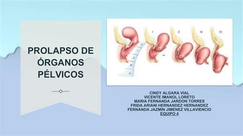 Diagrama de prolapso de órganos pélvicos mostrando el descenso de la vejiga, útero y recto