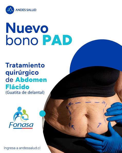 Esquema de abdomen flácido o guatita de delantal