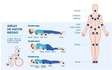Infografía que muestra las zonas de riesgo: talones, glúteos, codos, parte posterior de la cabeza y espalda.