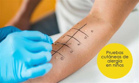 Ilustración de las pruebas cutáneas (prick test) para la detección de alérgenos alimentarios
