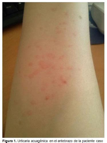 Representación esquemática de la piel con habones de urticaria acuagénica.