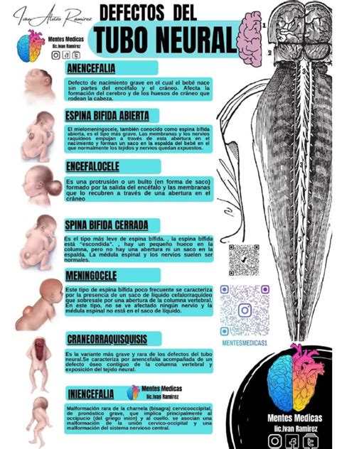Infografía mostrando los defectos del tubo neural y cómo la fortificación con ácido fólico ayuda a prevenirlos.