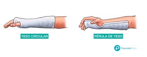 Infografía comparativa: Yeso vs. Férula en el tratamiento de fracturas leves.