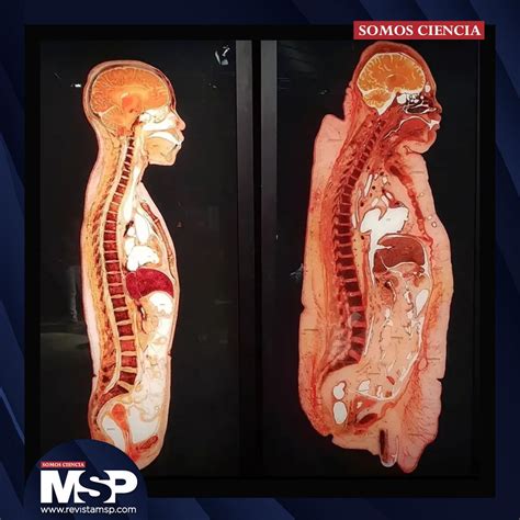 Esquema anatómico que muestra la diferencia entre un pecho con ptosis (caído) y la corrección tras una mastopexia.