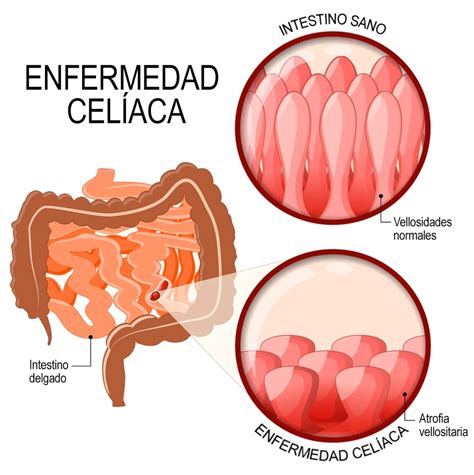 Ilustración esquemática del intestino delgado afectado por la enfermedad celíaca, mostrando la atrofia de las vellosidades intestinales.