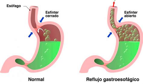 Ilustración que muestra el mecanismo del reflujo gastroesofágico, con el ácido estomacal subiendo hacia el esófago y el área del pecho.