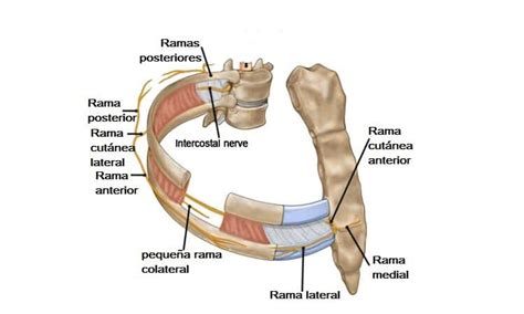Diagrama de los nervios intercostales que discurren entre las costillas, mostrando posibles puntos de irritación.