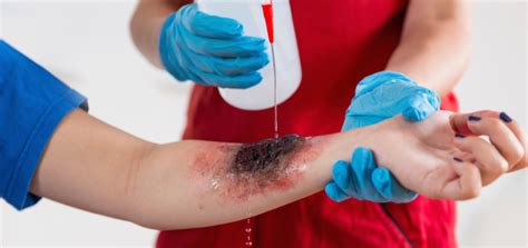 Ilustración de daños internos causados por quemaduras eléctricas