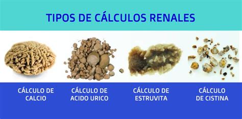 Esquema de formación de cálculos renales