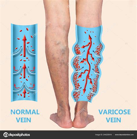 Ilustración de varices en las piernas