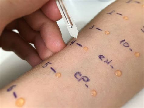 Ilustración que muestra cómo se realiza una prueba cutánea de alergia, con un profesional aplicando un extracto y observando la reacción en la piel.