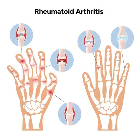 Ilustración de articulaciones afectadas por artritis reumatoide.