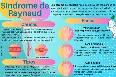 Infografía comparando el Fenómeno de Raynaud primario y secundario