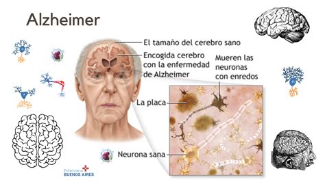 Esquema de la progresión de la enfermedad de Alzheimer, mostrando el deterioro cognitivo y la pérdida de autonomía en distintas etapas