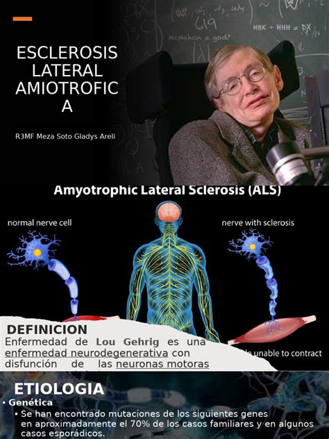 Infografía sobre la Esclerosis Lateral Amiotrófica (ELA), mostrando neuronas motoras sanas y degeneradas