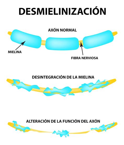 Mapa cerebral mostrando las áreas afectadas por placas de desmielinización en la Esclerosis Múltiple