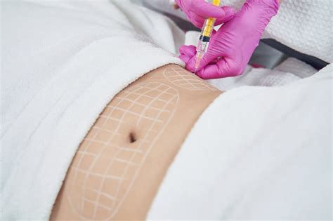 Diagrama de las zonas del cuerpo tratadas con mesoterapia para grasa localizada y celulitis