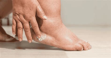 Ilustración de las principales causas del edema en los pies: corazón, riñones, hígado, sistema linfático y venoso.