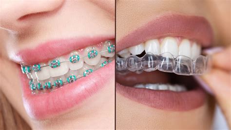 Esquema de tipos de brackets y alineadores dentales