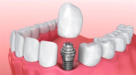Ilustración de un implante dental con corona