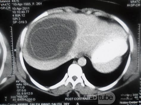 Imagen de TC de un quiste hidatídico gigante en el abdomen