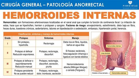 Esquema anatómico del canal anal mostrando la diferencia entre hemorroides internas y externas