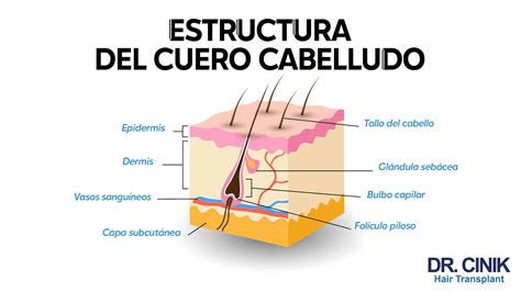 Ilustración que muestra la estructura de un folículo capilar debilitado