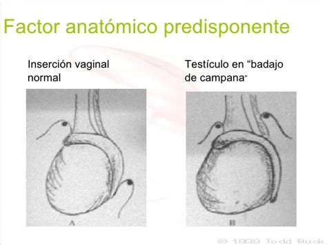 Ilustración de un testículo con fijación normal vs. fijación en badajo de campana que predispone a la torsión