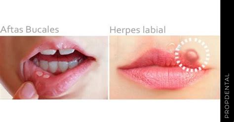 Ilustración que muestra la diferencia entre aftas bucales y herpes labial, con detalles sobre sus causas y contagiosidad.