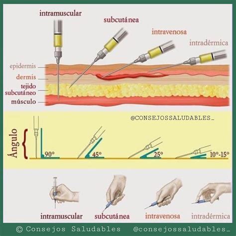 Diagrama de las zonas anatómicas para inyección intramuscular (muslo, cadera, brazo y glúteo)