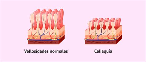 infografía detallando el proceso de daño en las vellosidades intestinales causado por el gluten en celíacos
