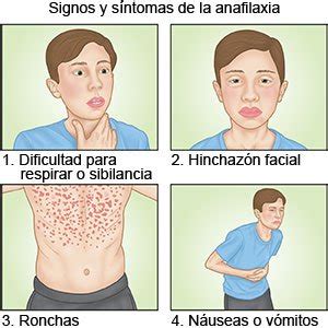 Ilustración de los síntomas de la anafilaxia