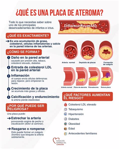 Esquema de las arterias afectadas por placas de ateroma debido al colesterol