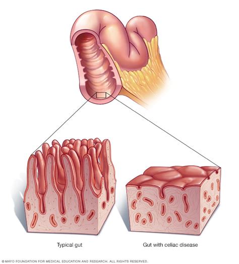 Esquema de la reacción del intestino en personas celíacas frente al gluten