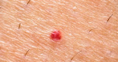 Fotografía comparativa de un angioma capilar y una pápula benigna